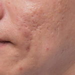 acne-scars-3-Rx,-Lt---Peng_Before