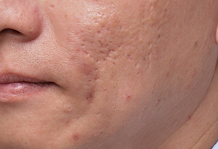 acne-scars-3-Rx,-Lt---Peng_Before