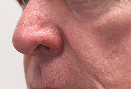 Rhinophyma-A-Manuvali_After