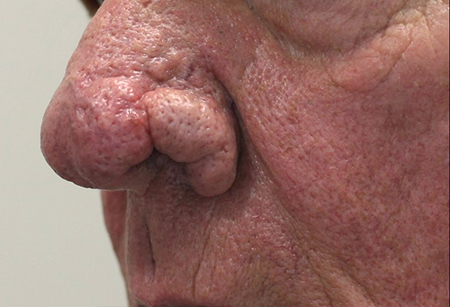 Rhinophyma-A-Manuvali_BEFORE