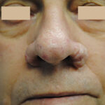 Rhinophyma_Before