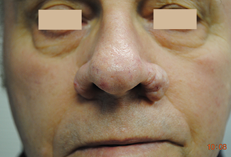 Rhinophyma_Before