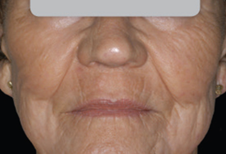 skin-resurfacing---after---Kilmer_After