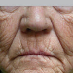 skin-resurfacing---after---Kilmer_Before