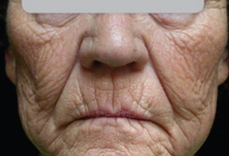 skin-resurfacing---after---Kilmer_Before