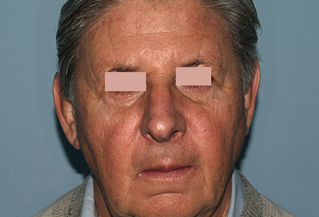 Blepharoplasty_After