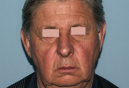 Blepharoplasty_Before