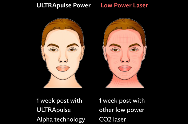 The Power Advantage of ULTRApulse Alpha